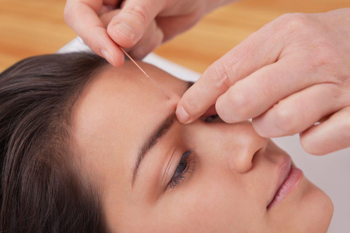 Acupuncture Experience
