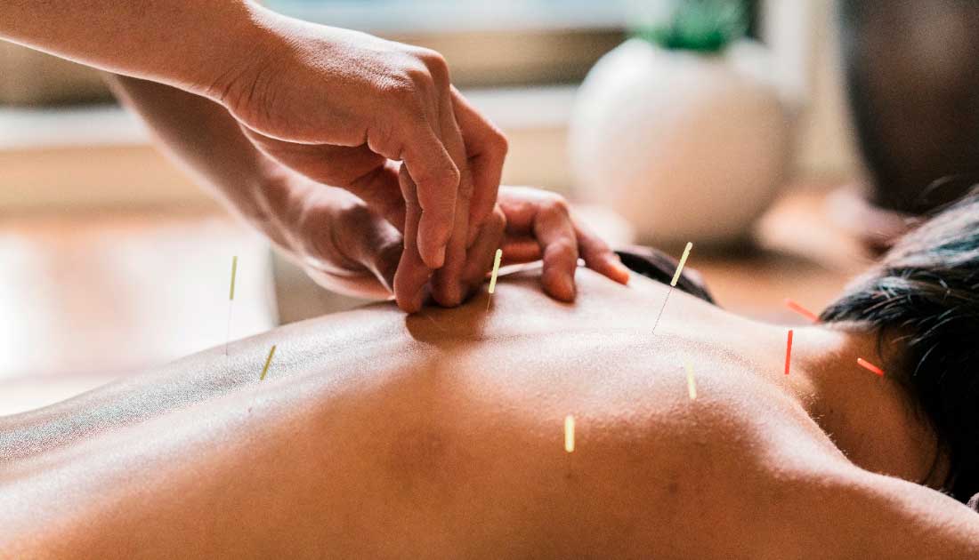Acupuncture Experience